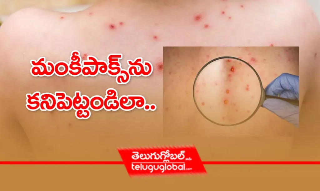 మంకీపాక్స్‌ను కనిపెట్టండిలా..